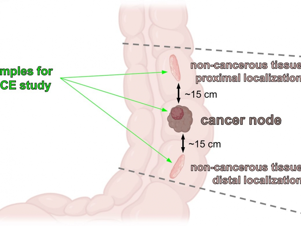 Image for Нижегородские ученые придумали, как быстро диагностировать колоректальный рак